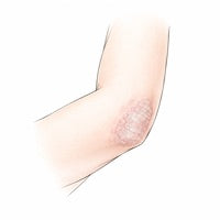 Psoriasis : le lien entre peau et intestin