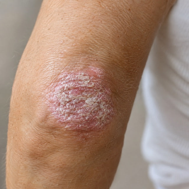 Psoriasis : le lien entre peau et intestin