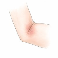 Eczéma : et si la solution venait de ton ventre ?