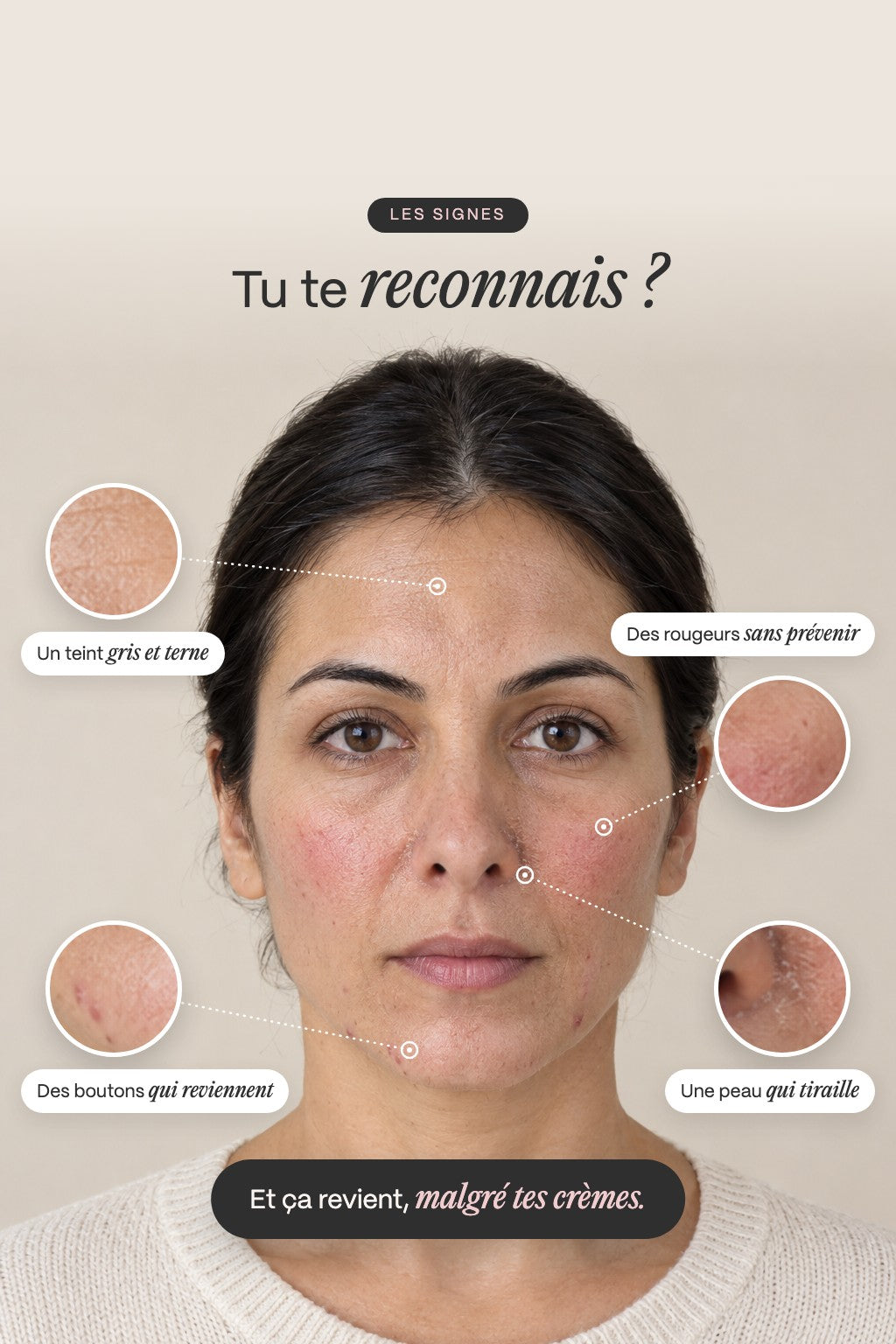 Tu te reconnais ? Boutons, teint terne, rougeurs, peau qui tiraille