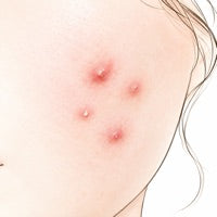 Acné : pourquoi tout commence dans ton ventre