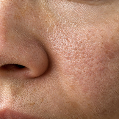 Pores dilatés