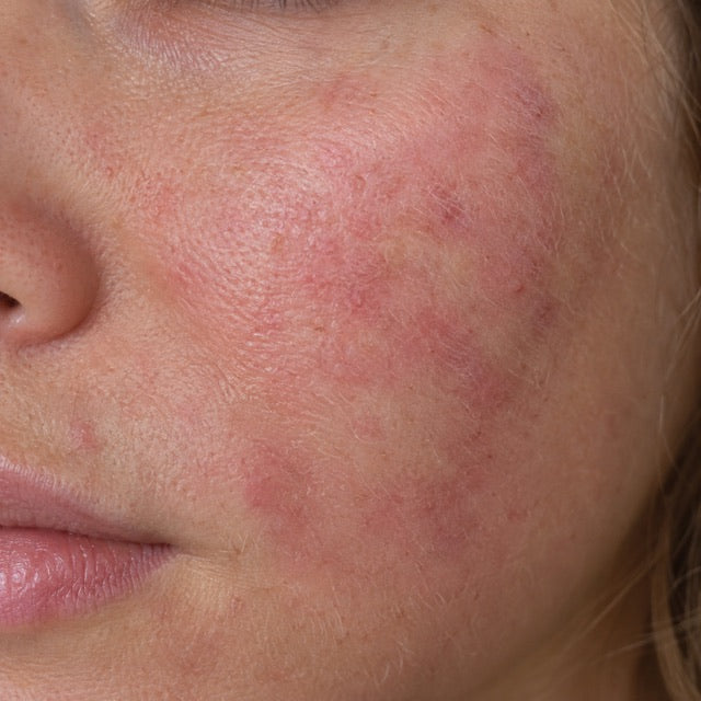 Peau sensible : et si ça venait de ton intestin ?