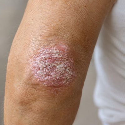 Psoriasis