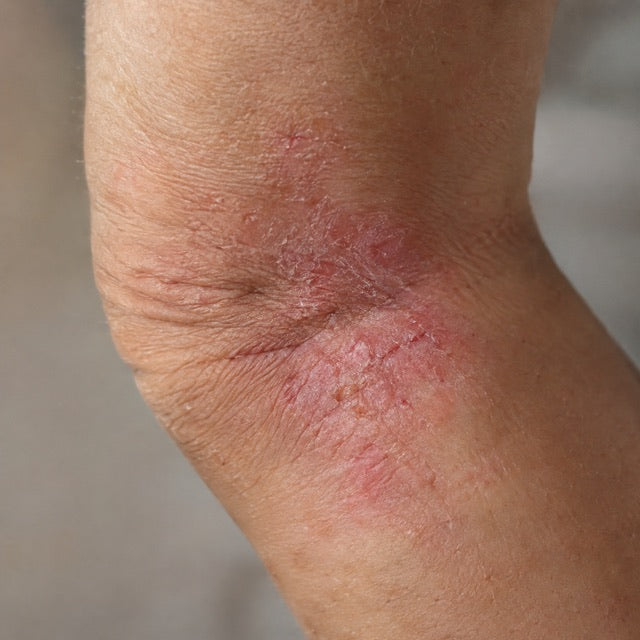 Eczéma : et si la solution venait de ton ventre ?