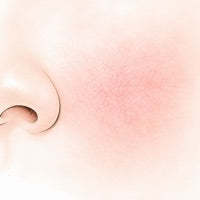 Rosacée : et si tout partait de l'intestin ?