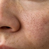 Pores dilatés