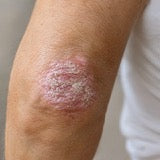 Psoriasis